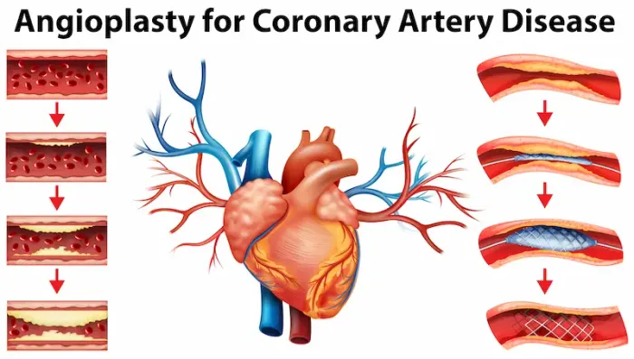 How To Take Care After Angioplasty